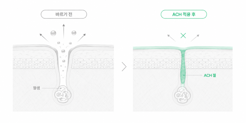 바르기 전과 ACH 적용 후 모공 단면 비교 일러스트